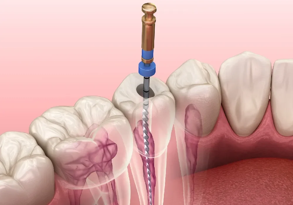 Endodontia